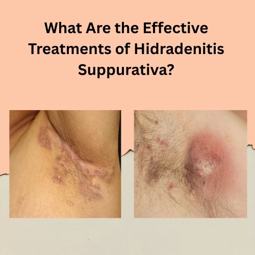 What Are the Effective Treatments of Hidradenitis Suppurativa? - Natural Health News
