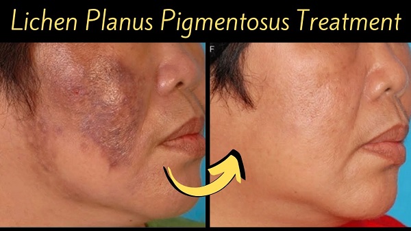 Living with Lichen Planus Pigmentosus: Expert Tips for Skin Care - Herbal Care Products - Blog