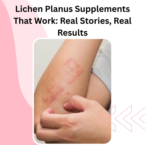 Lichen Planus Supplements That Work: Real Stories, Real Results - Herbal Care Products - Blog