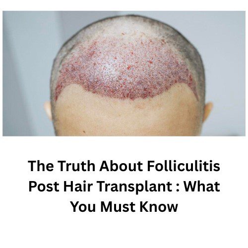 The Truth About Folliculitis Post Hair Transplant: What You Must Know - Herbal Care Products - Blog