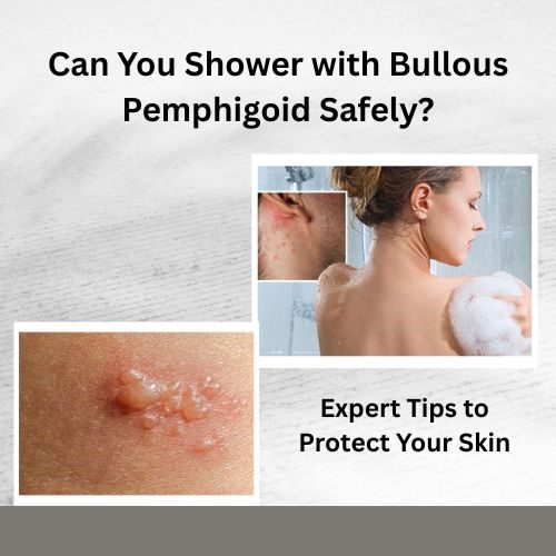 Can You Shower with Bullous Pemphigoid Safely? Expert Tips to Protect Your Skin - Herbal Care Products - Blog