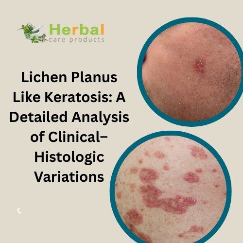 Lichen Planus Like Keratosis: A Detailed Analysis of Clinical–Histologic Variations - Herbal Care Products - Blog