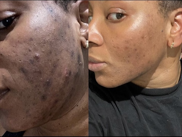 Best Skin Care & Acne Treatment Kentish Town & Islington