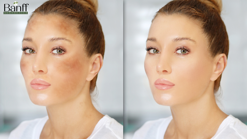 Medical Aesthetics Toronto: Best Hyperpigmentation Treatments for Clear Skin