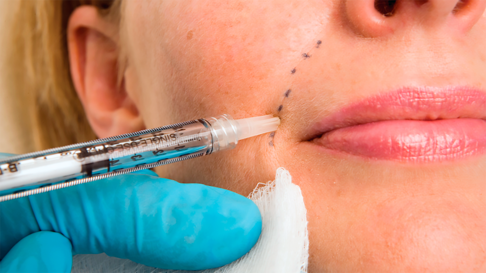 Expert Dermal Fillers Treatments in San Antonio & Live Oak, TX