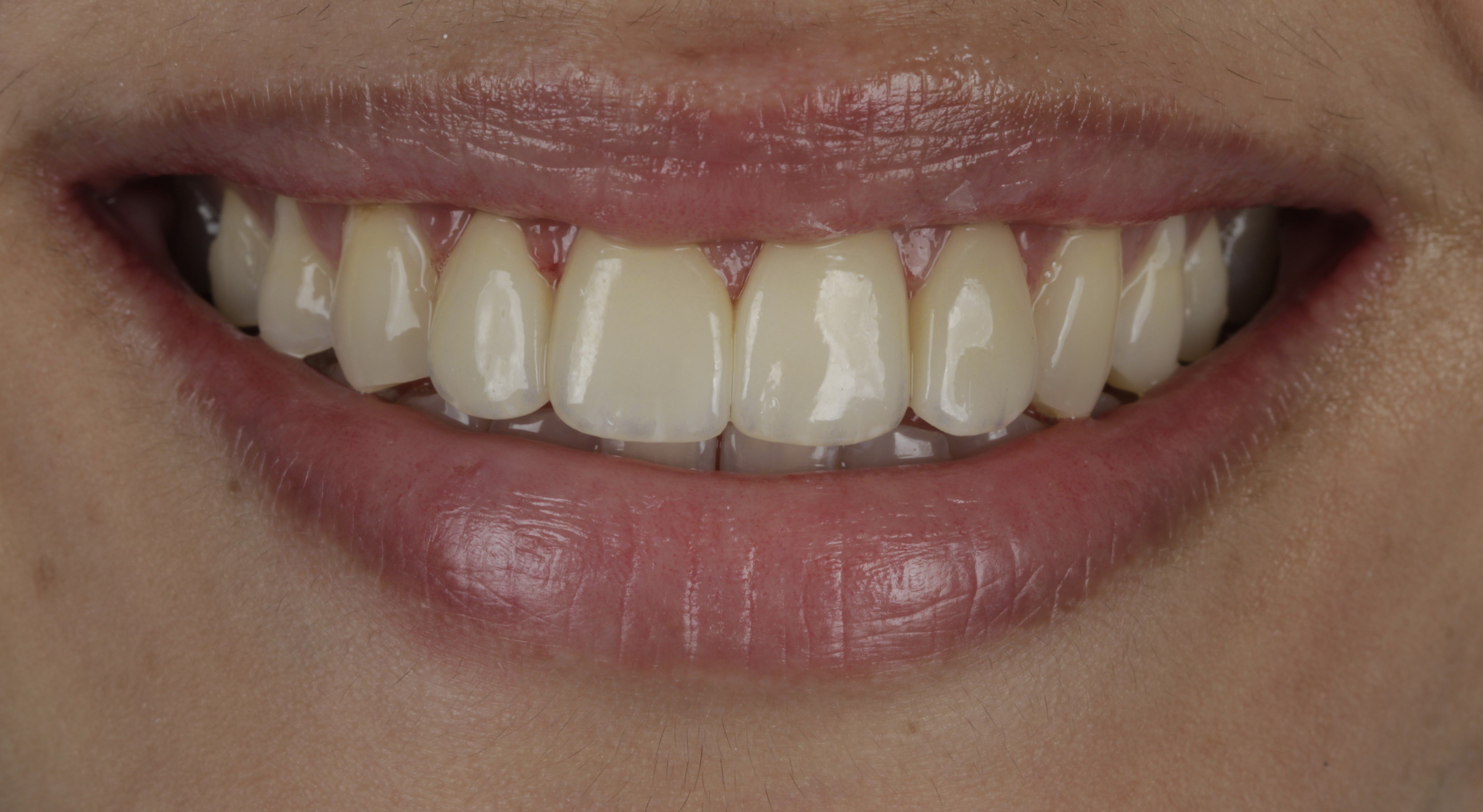 Smile Makeover Clinic in Delhi | Best Cosmetic Dentist in delhi | Dr. Kamala Dental Care