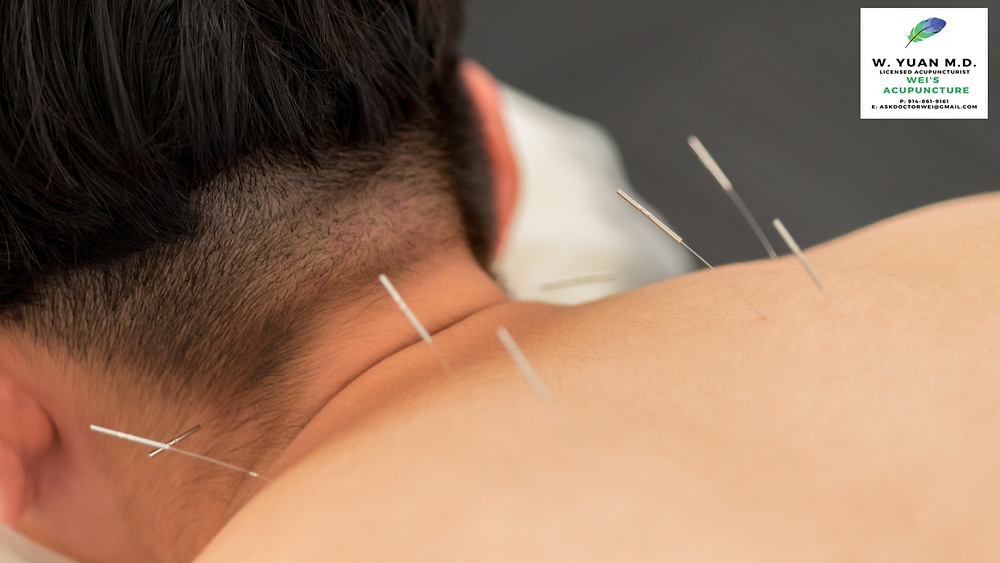 Stop Living With Neck Pain: How Acupuncture in New York Can Help