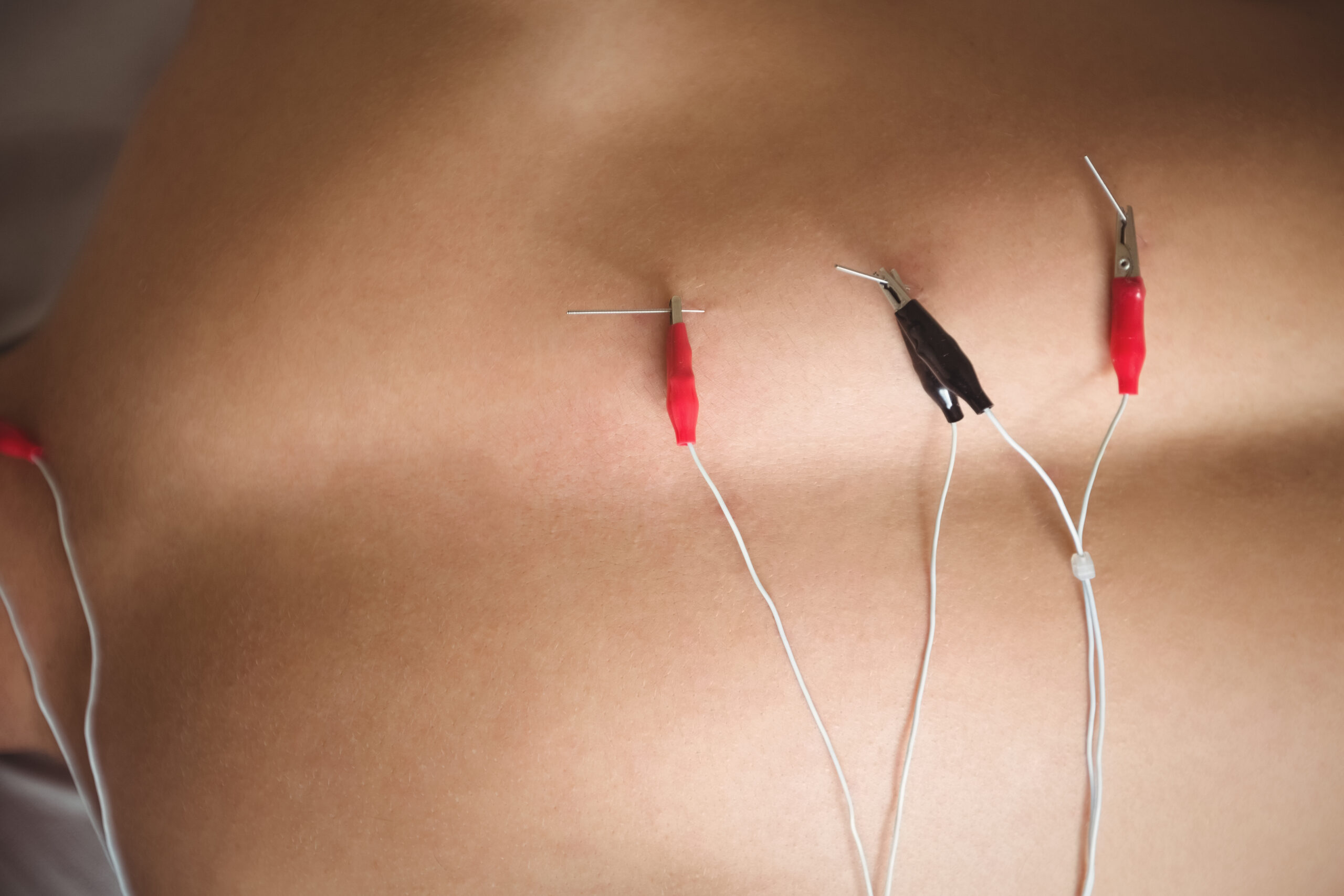 Electro Acupuncture: How Electrical Stimulation Enhances Traditional Acupuncture – Buy Smart Price