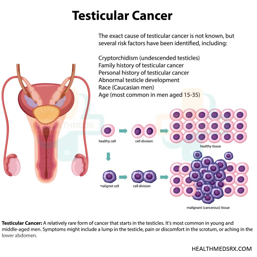 Testicular Cancer- Symptoms, Sure shot Preventions Tips