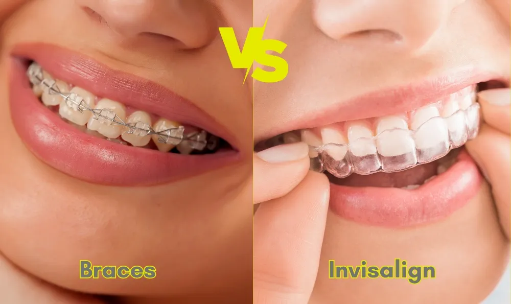 How Do Invisalign Clear Aligners Work to Straighten Teeth Without Braces? – Collins Road Family Dental