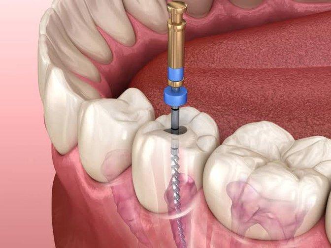 Can a Tooth Need a Root Canal Even If It Doesn't Hurt? | Articles | Cheema Dental & Orthodontics | Gan Jing World - Technology for Humanity | Video & Movie Streaming
