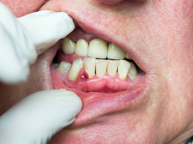 Can an Infected Tooth Become a Dental Emergency?