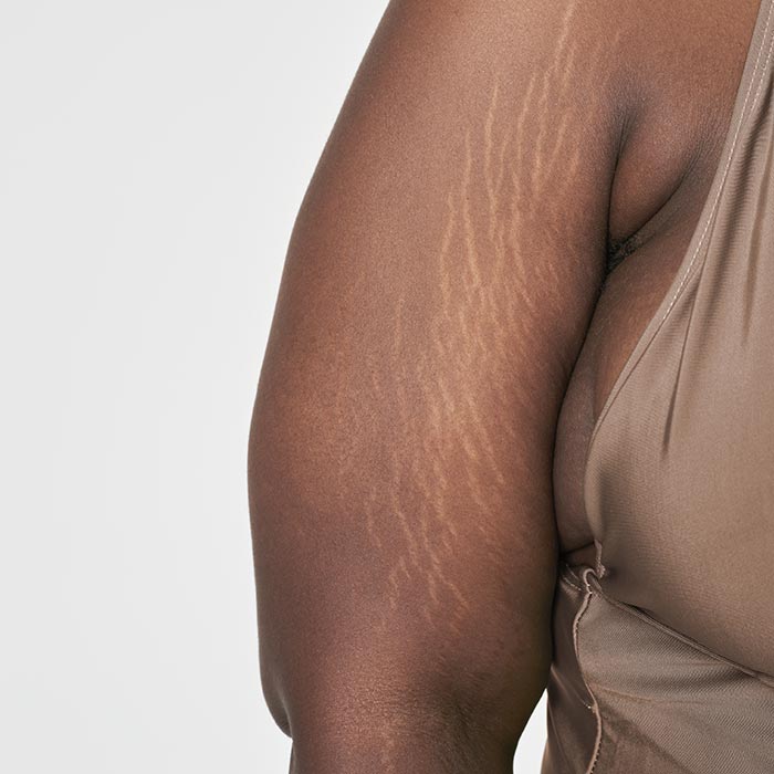 Scars and Stretch Marks Treatment in Mississauga