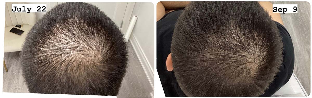 PRP for Hair & Skin Treatment Mississauga | Glamderm